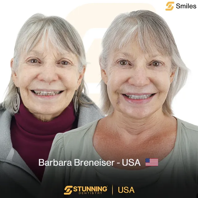 Smile Makeover, USA - photo 3